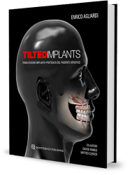 Tilted implants