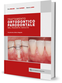 Trattamento ortodontico parodontale nel paziente adulto