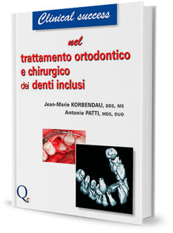 Trattamento ortodontico e chirurgico dei denti inclusi