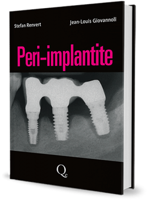 Peri-Implantite